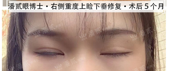 上睑下垂手术是不是永远闭不上眼,做了上睑下垂手术后怎么护理眼睛