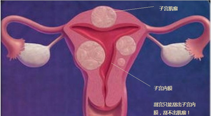 子宫肌瘤会不会恶变,子宫肌瘤1个月增长1cm是不是恶变