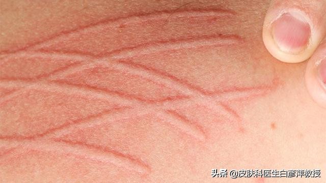 没有症状的瘙痒有什么方法治疗,皮肤痒的受不了怎样快速止痒