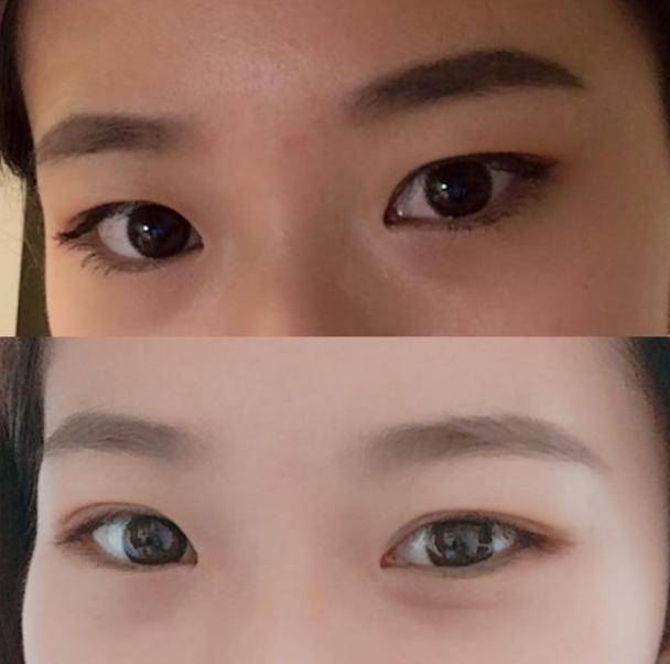 南华博士整形,南华双眼皮手术