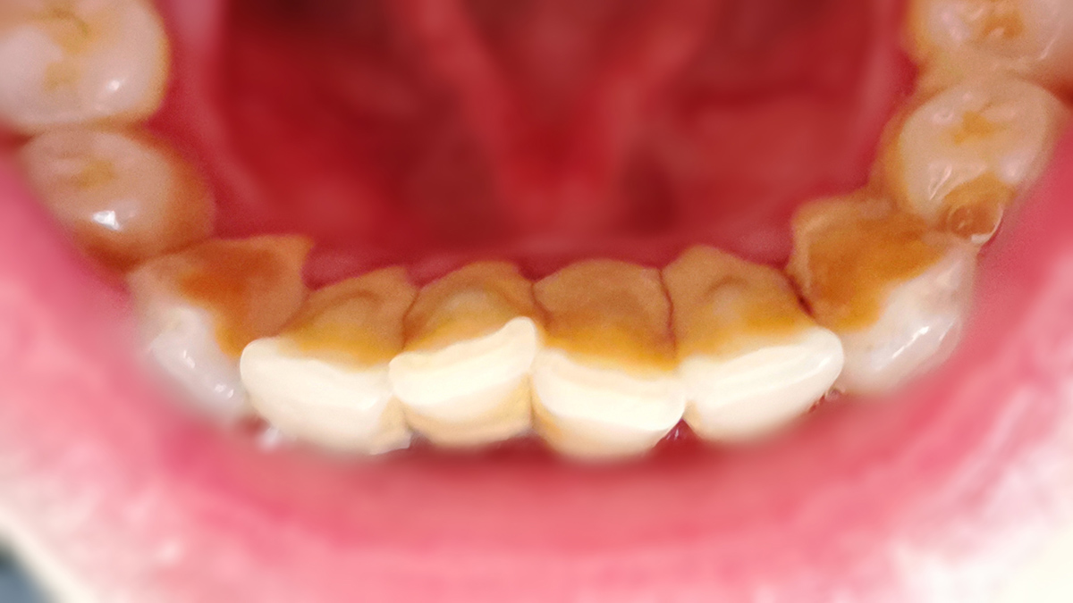 懒人刷牙神器洁牙仪测评,清除牙结石的牙刷测评