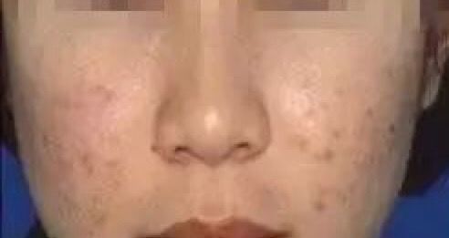 最简单的方法可以快速祛除痘印,如何有效且健康的祛除痘印