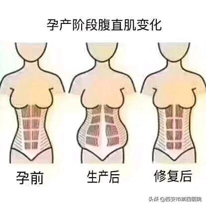 什么是腹直肌分离,腹直肌分离可以正骨修复吗