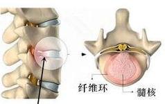 腰椎间盘突出脱出膨出的区别,腰椎间盘膨出和突出的中医治疗