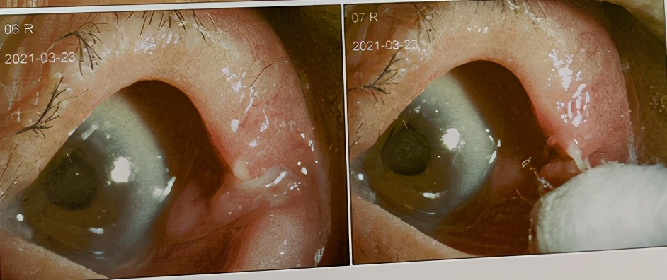 老人家倒睫毛怎么处理,老年眼睛倒睫怎么处理