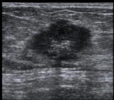 乳腺检查有疑似结节是什么意思,乳腺彩超报告中隐藏的秘密