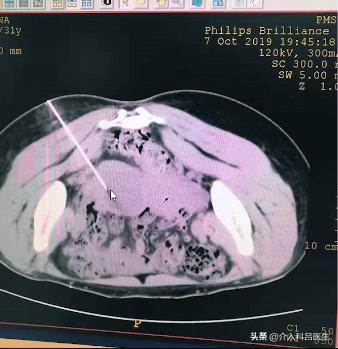 卵巢巧克力囊肿穿刺最佳时间,巧克力囊肿穿刺怎么做的视频