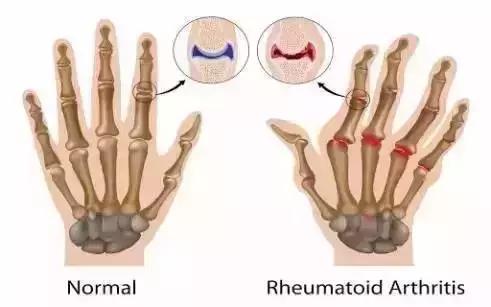 骨科看风湿好还是风湿科看风湿好,骨科科普肩膀篇