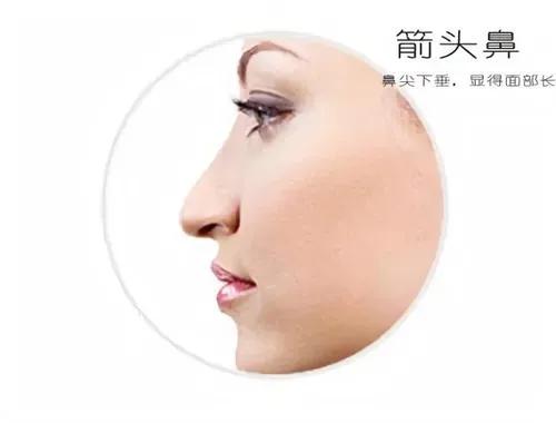 鹰钩鼻与哪种鼻子很相似,箭头鼻和悬胆鼻