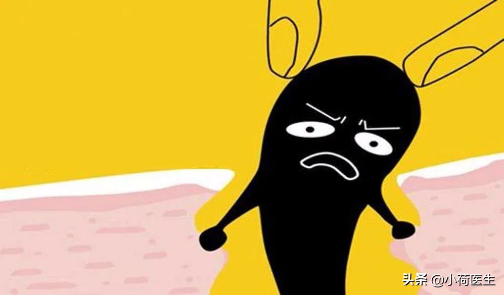 黑头怎么祛除最快最有效的方法,激光祛黑头可以让黑头变少吗