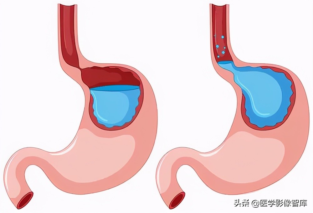 咽喉炎为什么要用治胃病的药