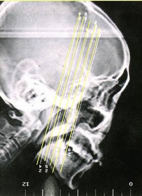 慢性鼻窦炎药物治疗原则,慢性鼻窦炎初步诊疗措施