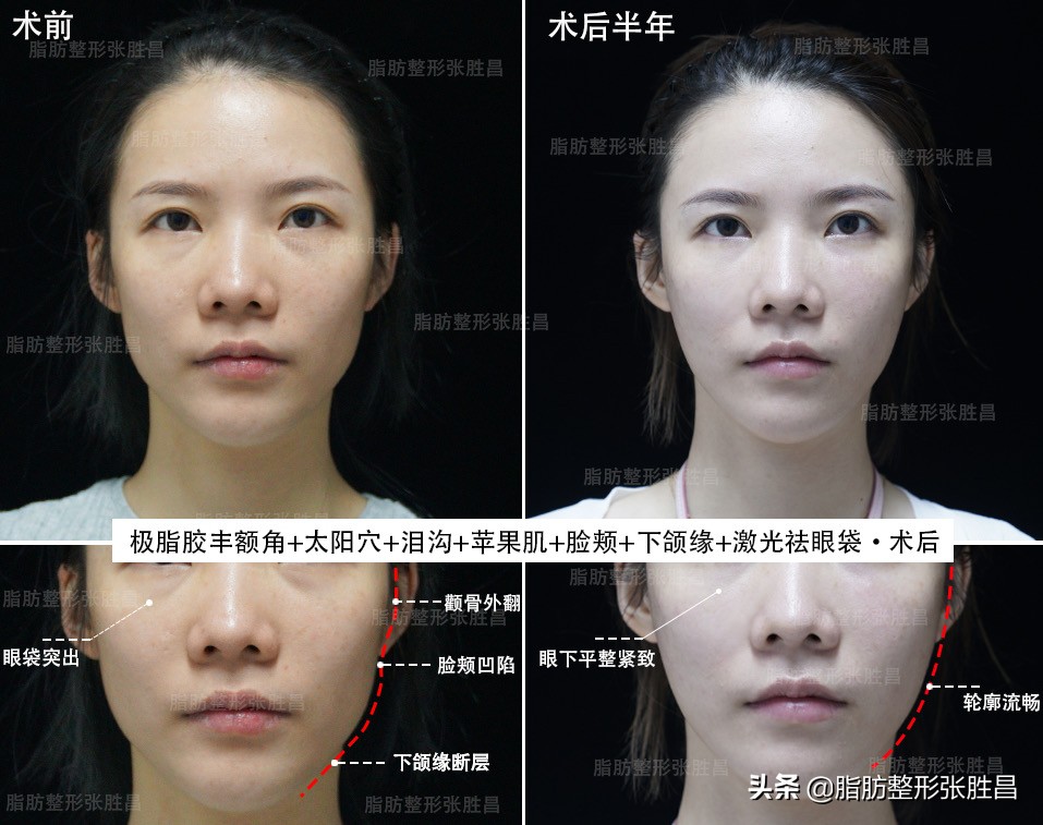 为什么脂肪填充要全麻,为什么脂肪填充算是整容