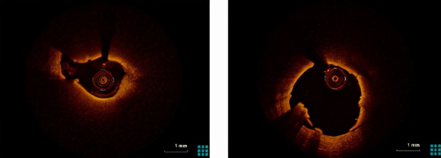 哈医大二院完成静脉桥血管再狭窄OCT指导下药物球囊介入治疗