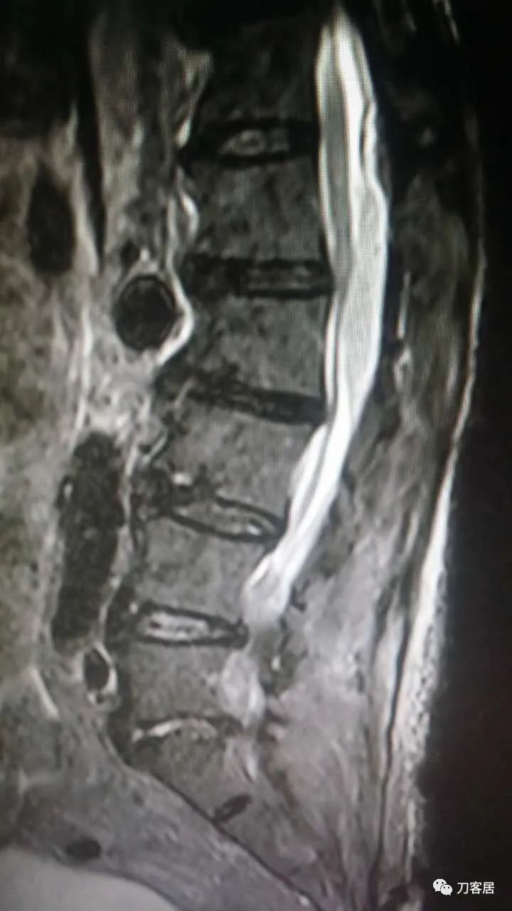 腰椎手术切掉棘突,腰突微创后出血肿