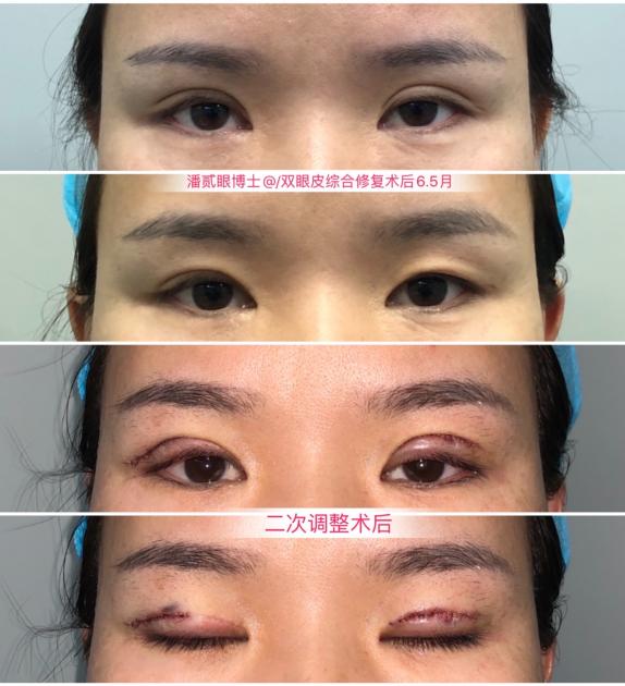 双眼皮太深显老怎么修复,双眼皮失败后修窄