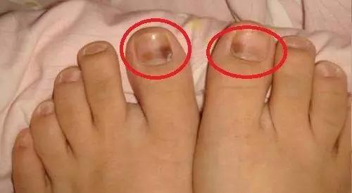 跑步跑出黑指甲怎么处理,跑步脚上出现黑趾甲该怎么处理