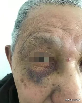 退休老教师遭暴打,大连老人娶保姆过户后被家暴