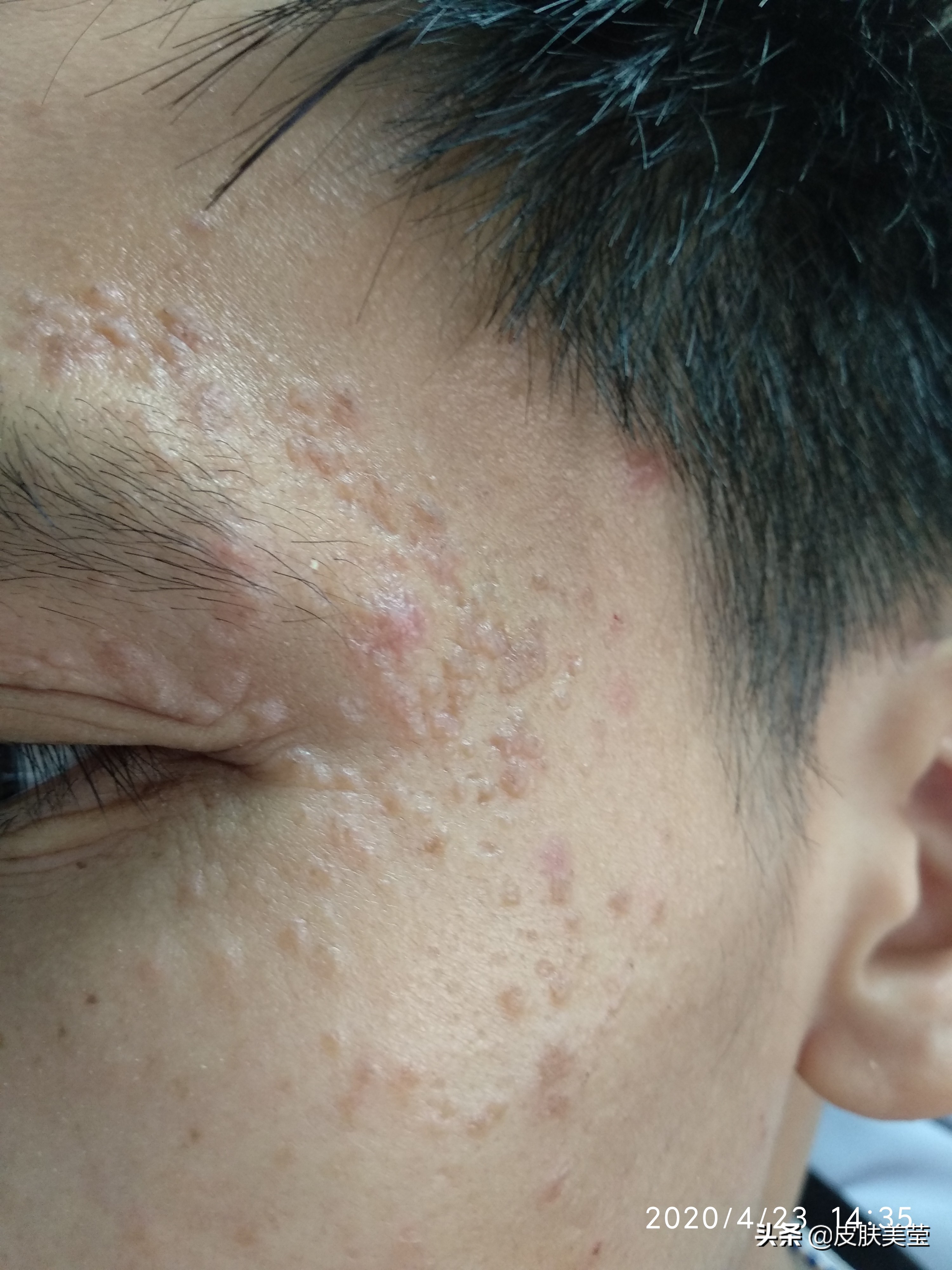 接种hpv疫苗可以预防其他癌症吗,hpv疫苗会让人感染hpv病毒吗