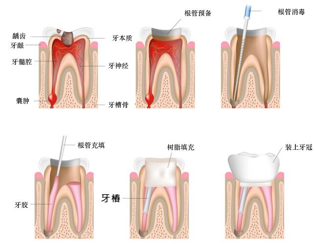 做完根管治疗有必要套牙冠吗,做完根管治疗一定要牙盖吗