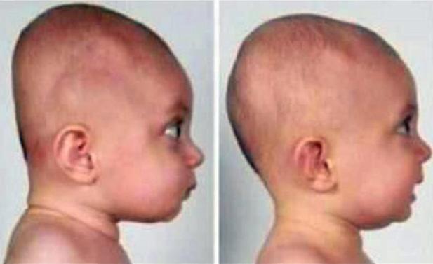 7个月的宝宝头睡扁了还能纠正吗,60天的婴儿后脑勺扁怎么矫正