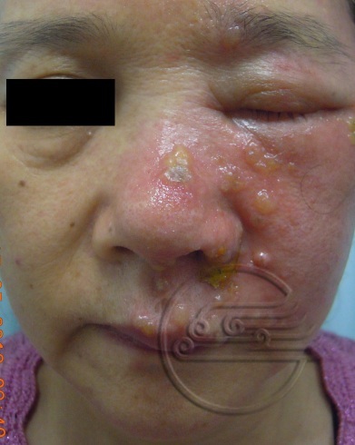 传染性软疣儿童怎么治可以断根,儿童脸上长了传染性软疣怎么办