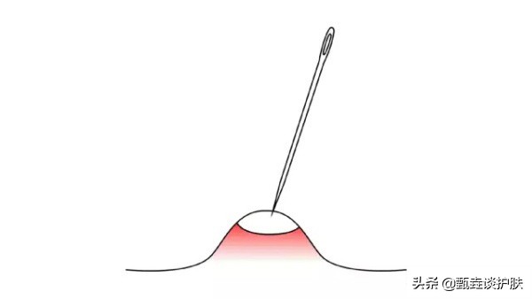 痘痘越挤越大越硬,痘痘黄了要不要挤