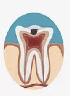 蛀牙不痛不杀神经能补牙吗,蛀牙不痛需要拔掉吗