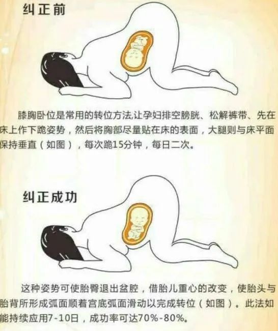 孕29周宝宝臀位需要纠正吗,29周臀位胎儿头在什么位置