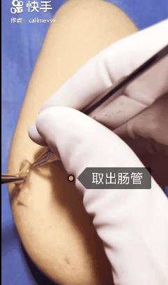 我在快手上看人切洋葱，竟然弄懂了剖腹产？