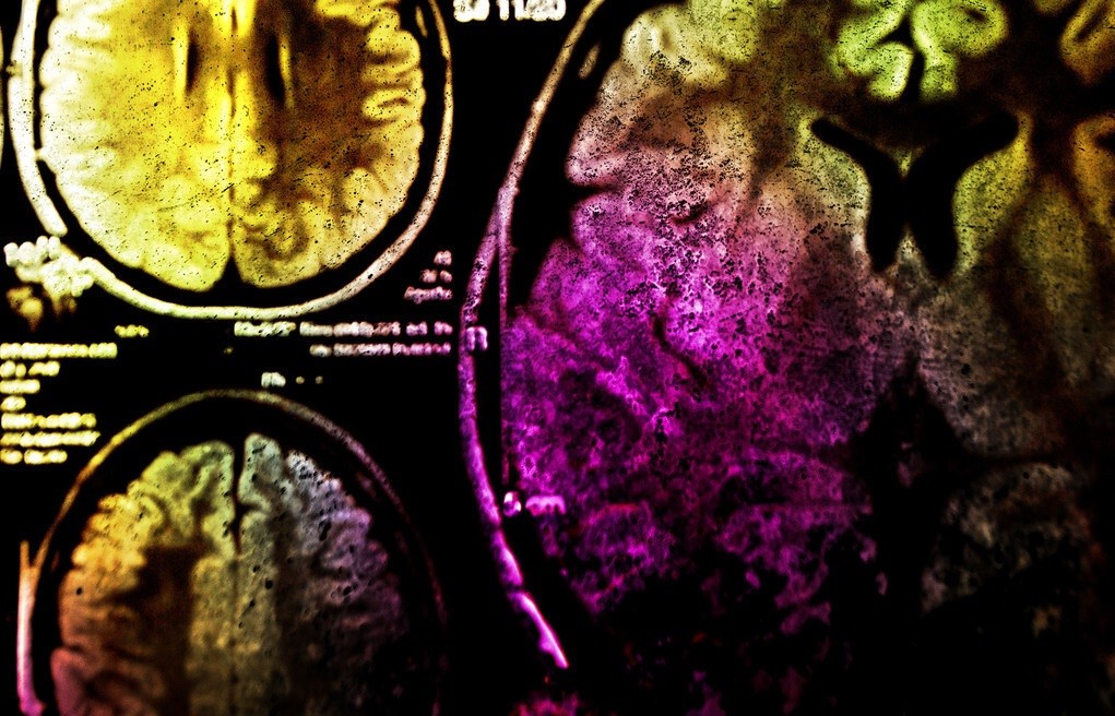 肿瘤免疫治疗的故事连载二十四,肿瘤免疫治疗的故事