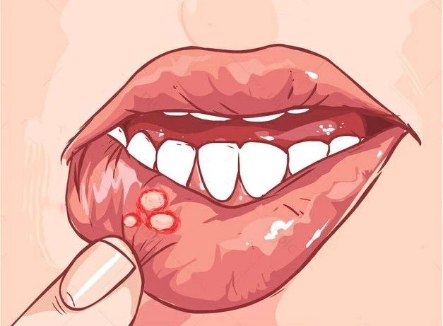 拔牙矫正牙齿后口腔溃疡怎么办,矫正牙齿后经常口腔溃疡怎么办