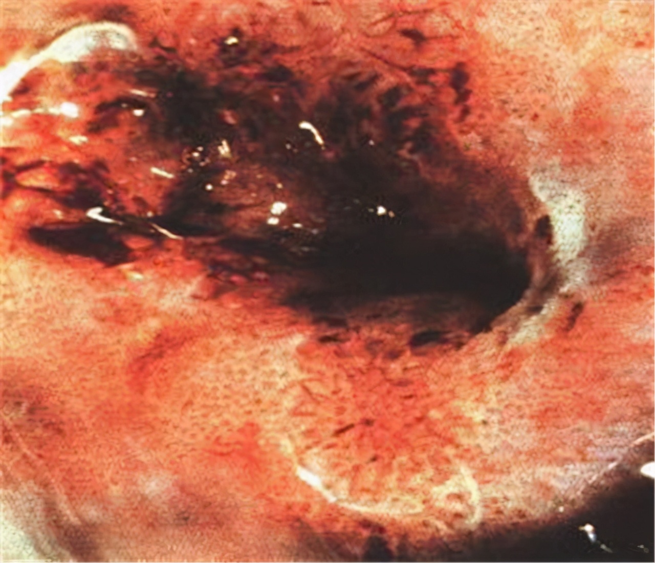 28岁女博士查出宫颈癌，平时洁身自好，医生提醒：这1件事要注意