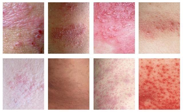 妈妈身上的湿疹总是好不了,宝宝得湿疹妈妈怎么忌口