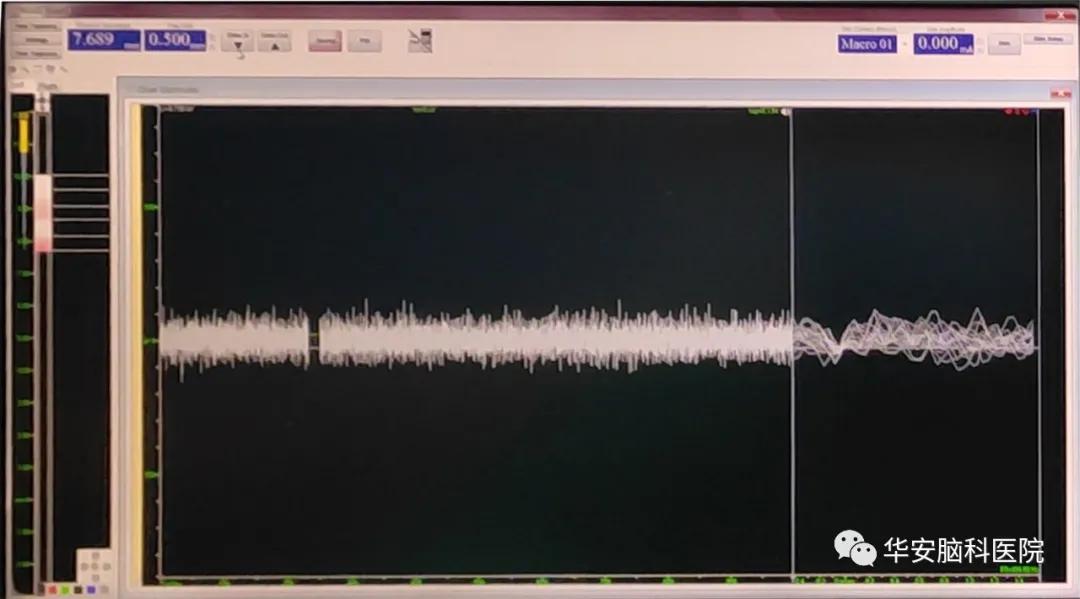 梅杰综合征dbs手术需要开颅吗,梅杰dbs手术住院需要几天