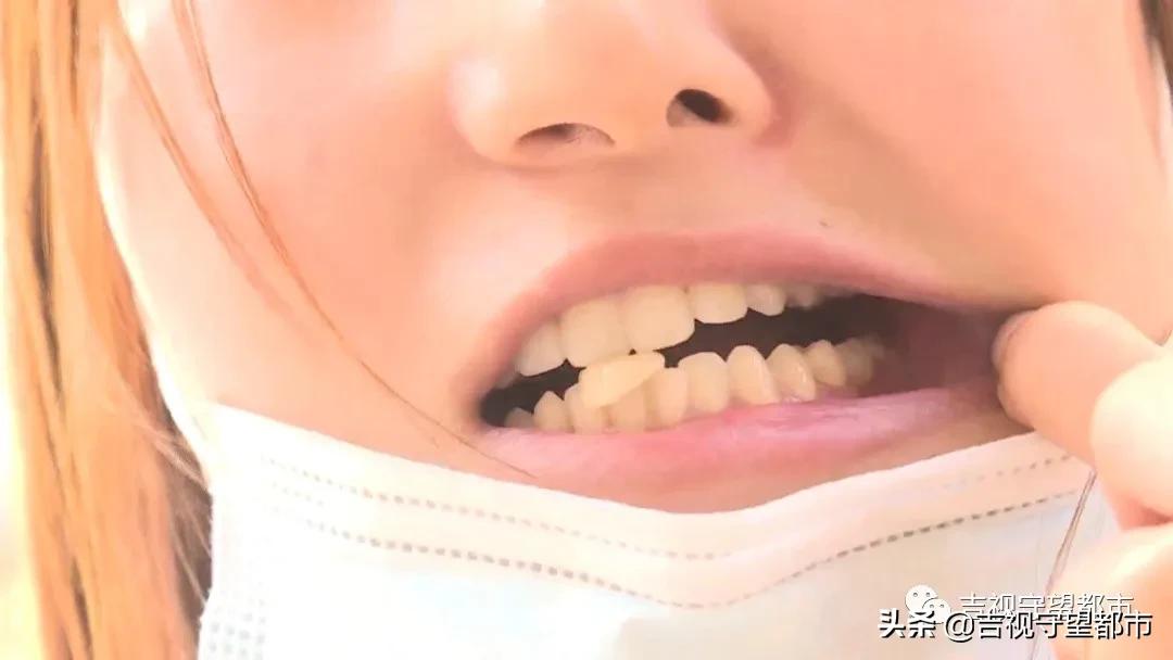 烤瓷牙里都烂成渣渣了,烤瓷牙太厚了要重新做吗