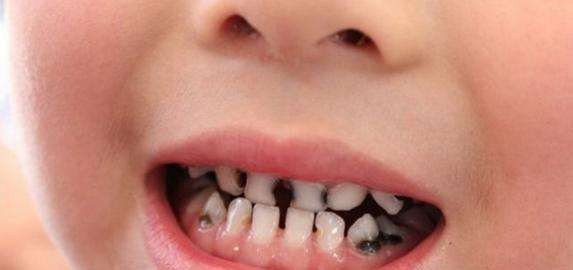 孩子牙齿有黑点是怎么回事,孩子牙齿有黑点怎么处理