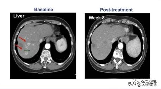 细胞激活治疗癌症的进展,细胞治疗新型癌症