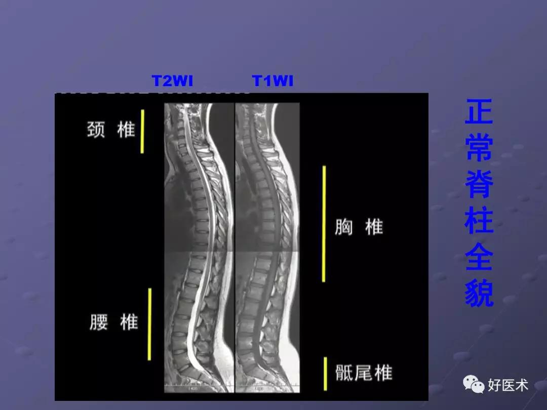 脊柱mri有哪些特点,乳腺疾病的mri诊断及鉴别