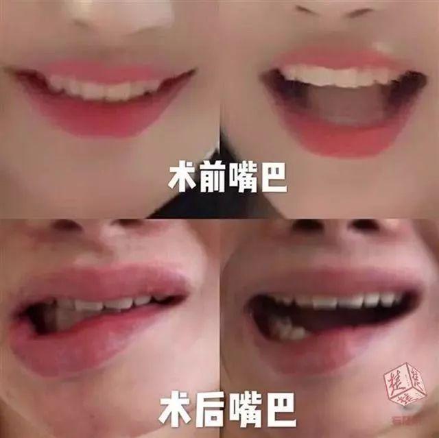 整容改脸型多少钱,女子花3万5整形结果