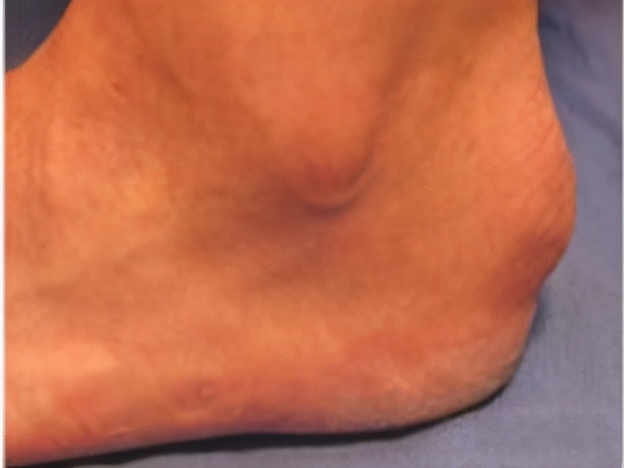 脚后跟上方2-3厘米有一个硬疙瘩疼,脚后跟长了一个包走路特别疼