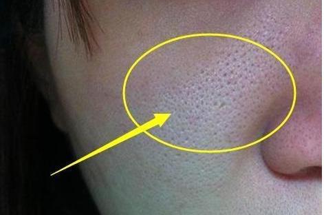 皮肤毛孔变大有脏东西怎么办,脸上毛孔粗大出油能挤出白色颗粒