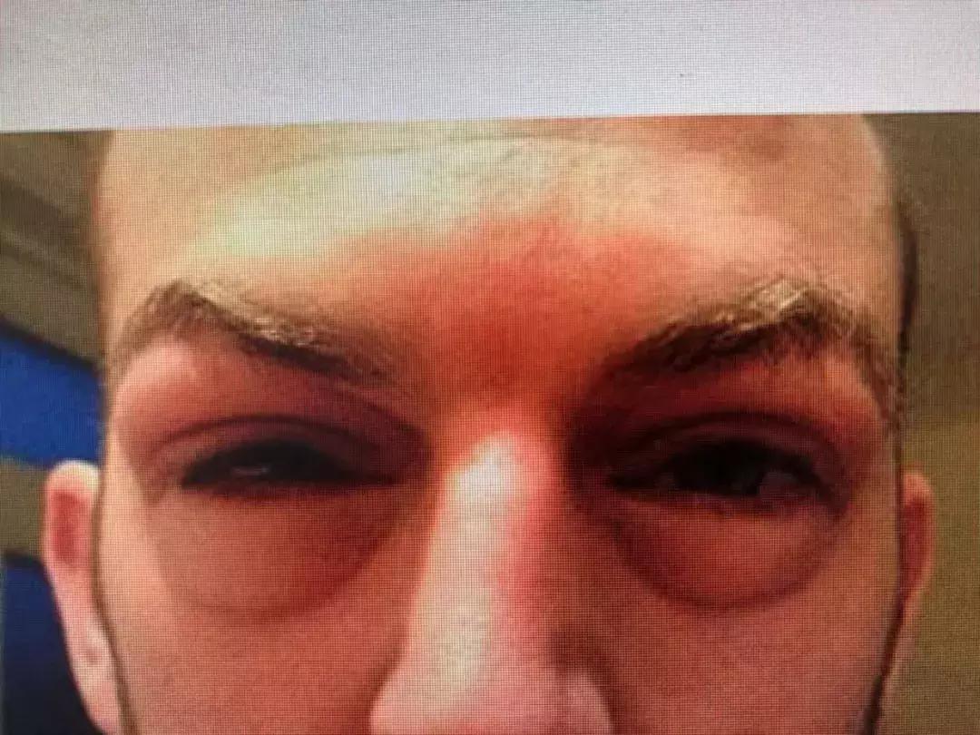 卧蚕越来越不明显的原因,卧蚕越来越明显的原因