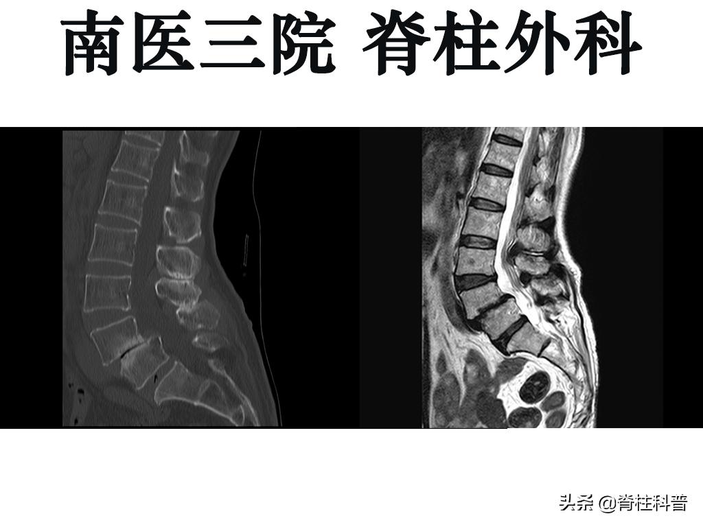 腰痛引起腰椎滑脱怎么治,十七岁腰椎痛怎么办