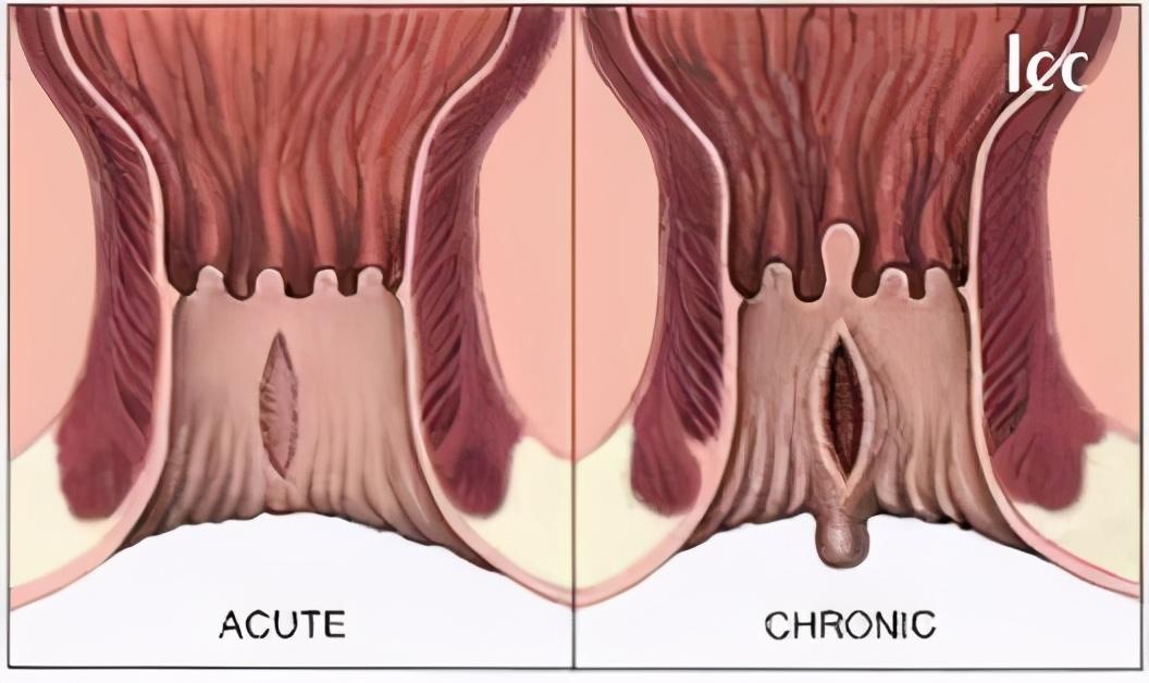 “肛裂”反复发作很痛苦怎么办？是选择保守还是手术治疗？
