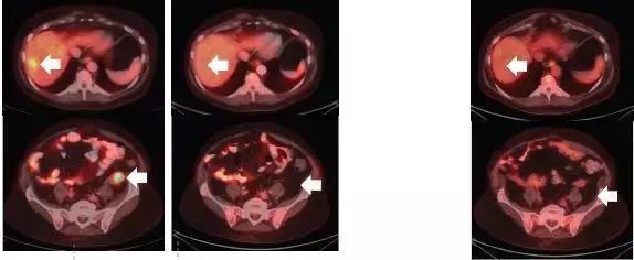 70种抗癌药新特效药,十大抗癌新药治疗癌症