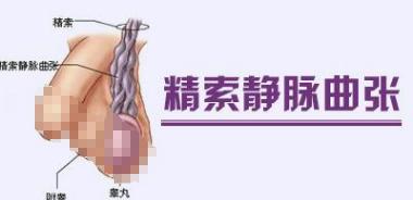 体检能检查出来精索静脉曲张,精索静脉曲张术后体检可以过关吗