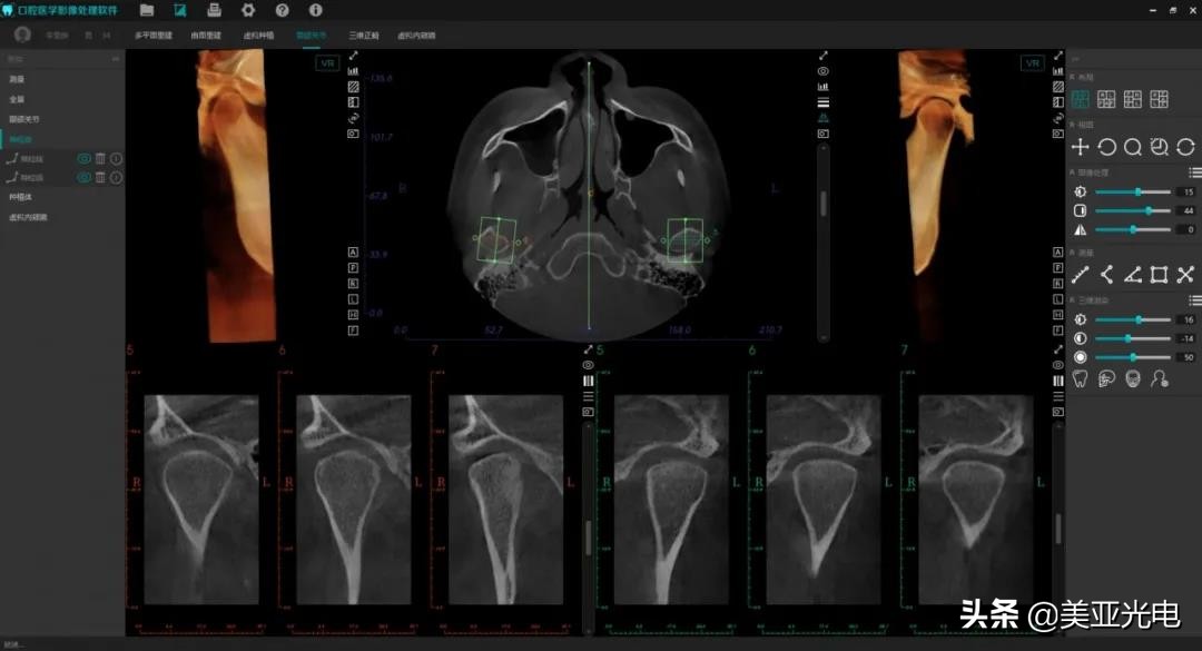 美亚口腔cbct全新局部ct功能上线,口腔cbct最好的品牌