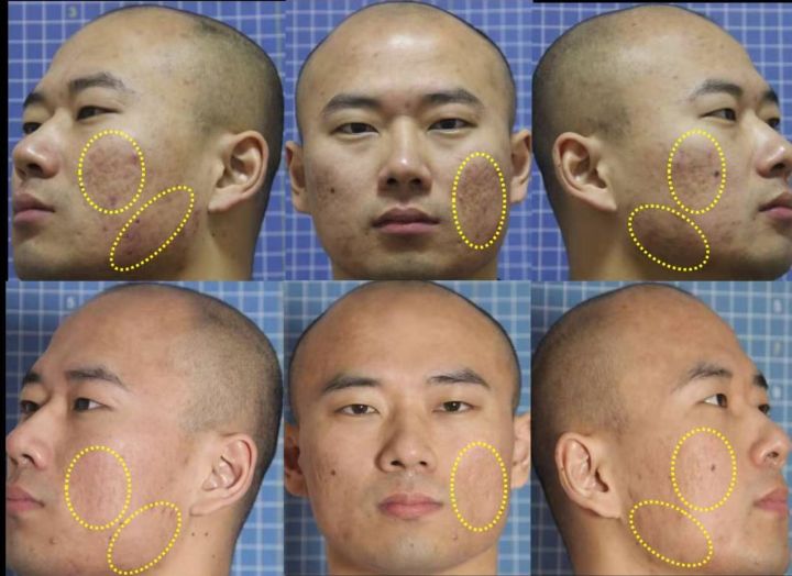 祛除痘坑痘印药膏,男士痘印痘坑怎么去除