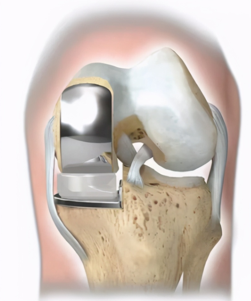 膝关节痛风肿胀疼痛怎么办,膝关节肿胀是痛风吗